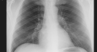 My chest
              x-ray