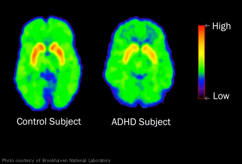 ADHD brains
