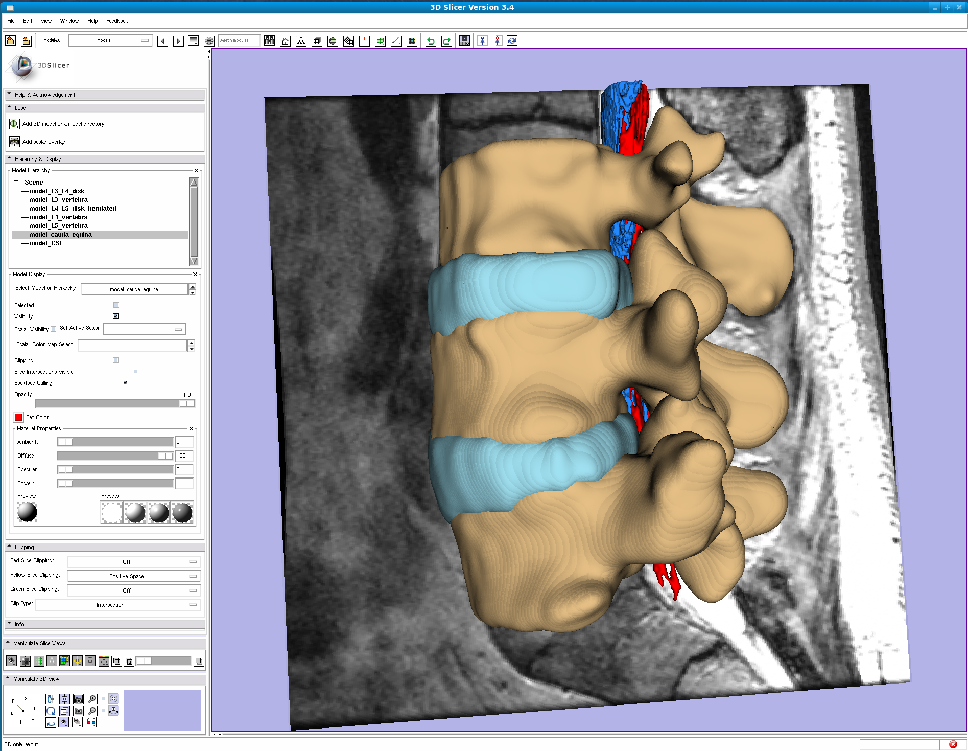 Sylvain Jaume - 3D Slicer surgical software platform