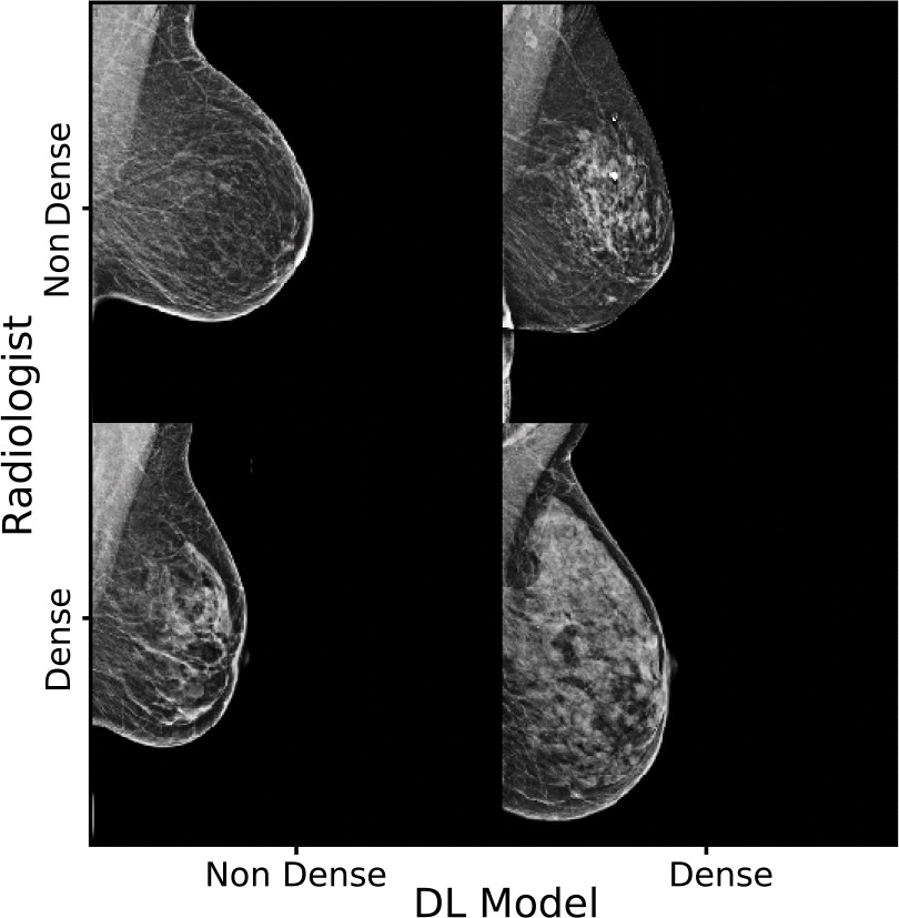 Mammographic Breast Density Assessment Using Deep Learning Clinical Implementation Tal Schuster