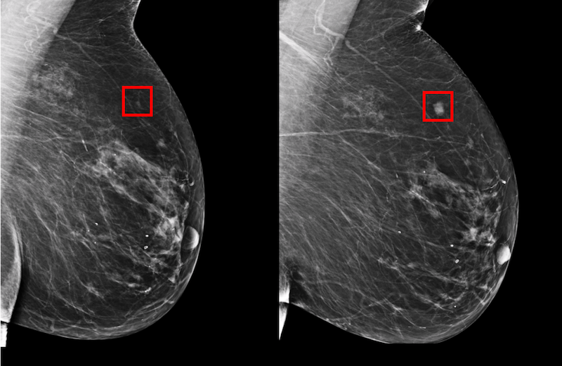 A Deep Learning Mammography-based Model For Improved Breast Cancer Risk ...